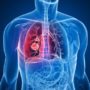 Express: лікарі вказують на три основні причини раку легенів
