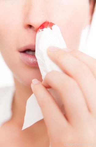 Як зупинити кров з носа?