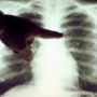 Кисень назвали однією з причин виникнення раку легенів