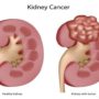 Рак нирки виявлять на ранній стадії
