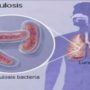Медики перерахували ранні симптоми туберкульозу