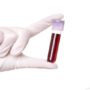 Група крові впливає на ризик тромбів