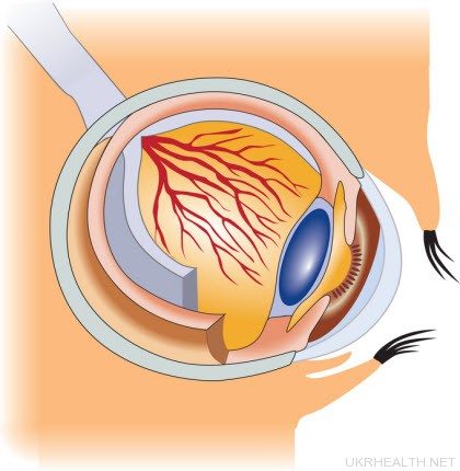 Закритокутова глаукома