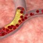 Головні причини появи в судинах холестеринових бляшок