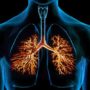 Як уникнути бронхітів і оздоровити легені: порада лікаря