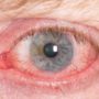 Червоні очі: 10 причин