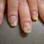 Зовнішній вигляд нігтів може розповісти про здоров’я людини