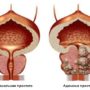 5 страшних історій про аденому простати