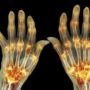 Ревматоїдний артрит: 12 ранніх ознак, які не можна ігнорувати