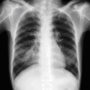 6 ознак раку легенів