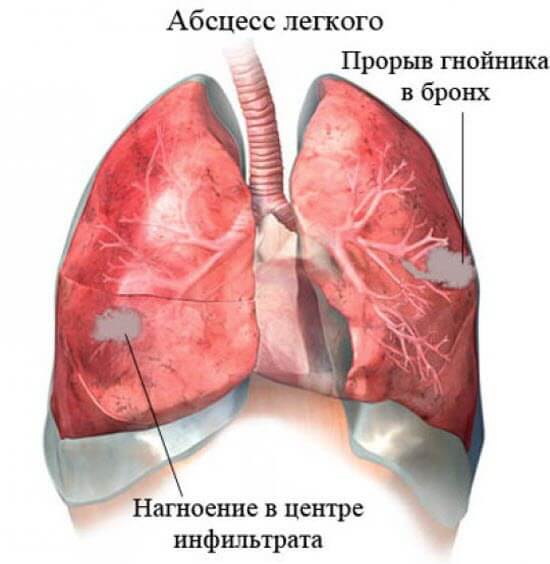 Абсцес легені