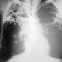 Туберкульоз: 7 дуже ранніх ознак, які важливо не пропустити