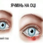 Медики розповіли, як правильно позбавлятися від ячменю на оці