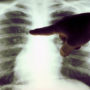 Онколог: Рак легенів найчастіше протікає безсимптомно