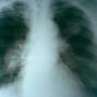 Названі 8 ключових симптомів раку легенів