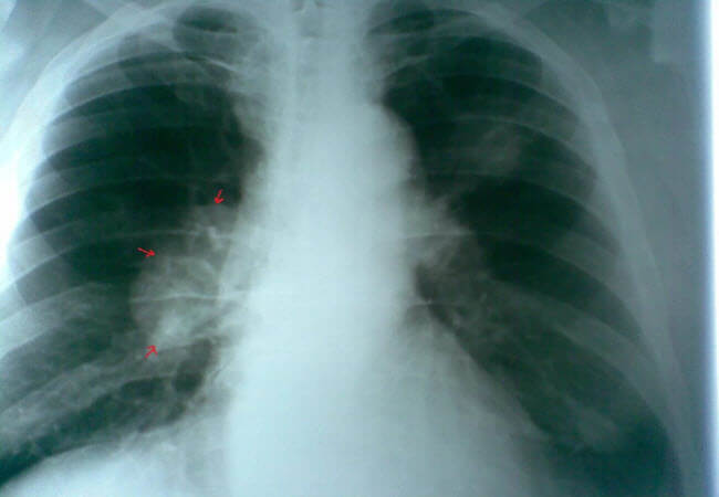 рак легенів