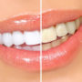 Популярні відбілювачі зубів завдають непоправної шкоди емалі