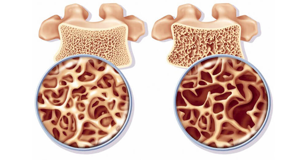 Остеопороз