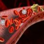 Як запобігти тромбоз: 8 продуктів для розрідження крові