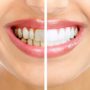 Як видалити зубний камінь природним шляхом?