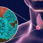 Як виявити пухлину: часті ознаки раку щитовидної залози, які можна упустити