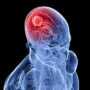 5 ранніх симптомів раку мозку