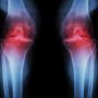 Хворі суглоби: як розпізнати перші симптоми остеоартрозу