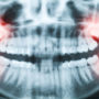 Стоматологи розповіли про користь зубів мудрості