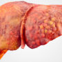 Названо найгірші продукти, які пошкоджують печінку