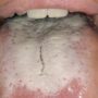 Білий наліт на язиці може бути ознакою небезпечних порушень в організмі
