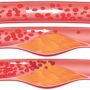 Атеросклероз: як виявити смертельно небезпечні зміни в судинах?