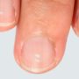 На які небезпечні порушення можуть вказувати білі смужки на нігтях?