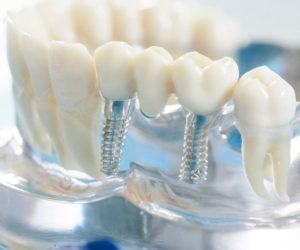 Протезування зубів