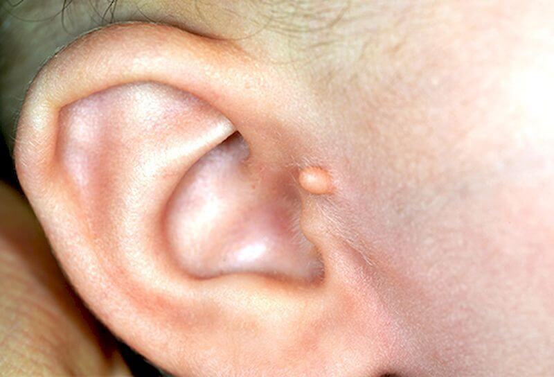 Незвичайна форма вуха