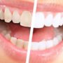 Експерти спростували п’ять найбільш популярних міфів про домашнє відбілювання зубів