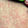 Пандемія COVID-19 може спровокувати спалах небезпечної інфекції – вчені