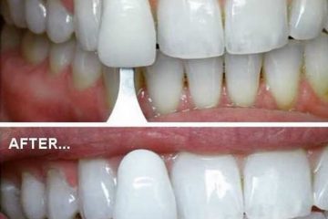Відбілювання зубів