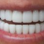 Стоматолог пов’язав чутливість зубів з особливостями раціону