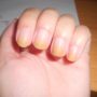 Жовті нігті, білі плями та інші зміни нігтів, які можуть бути небезпечними