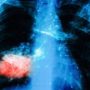 Лікарі назвали найпоширеніші симптоми раку легенів
