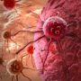 5 несподіваних симптомів раку, які потрібно виявити