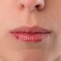Тріщини на губах: дерматологиня назвала причини