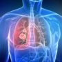 Онкологи з Канади назвали найбільш часті симптоми раку легенів