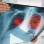 Онкологи: як розпізнати по обличчю рак легенів