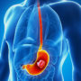 Дефіцит цього вітаміну подвоює ризик раку шлунка – симптоми