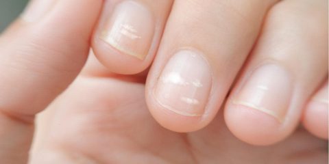 білі плями на нігтях
