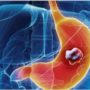 Як може виявлятися рак шлунка: ранні симптоми помітні після їжі та пиття