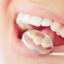 Названі способи збереження білизни зубної емалі