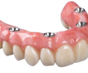 Протезы верхних зубов