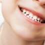 Три популярні звички, через які псуються зуби